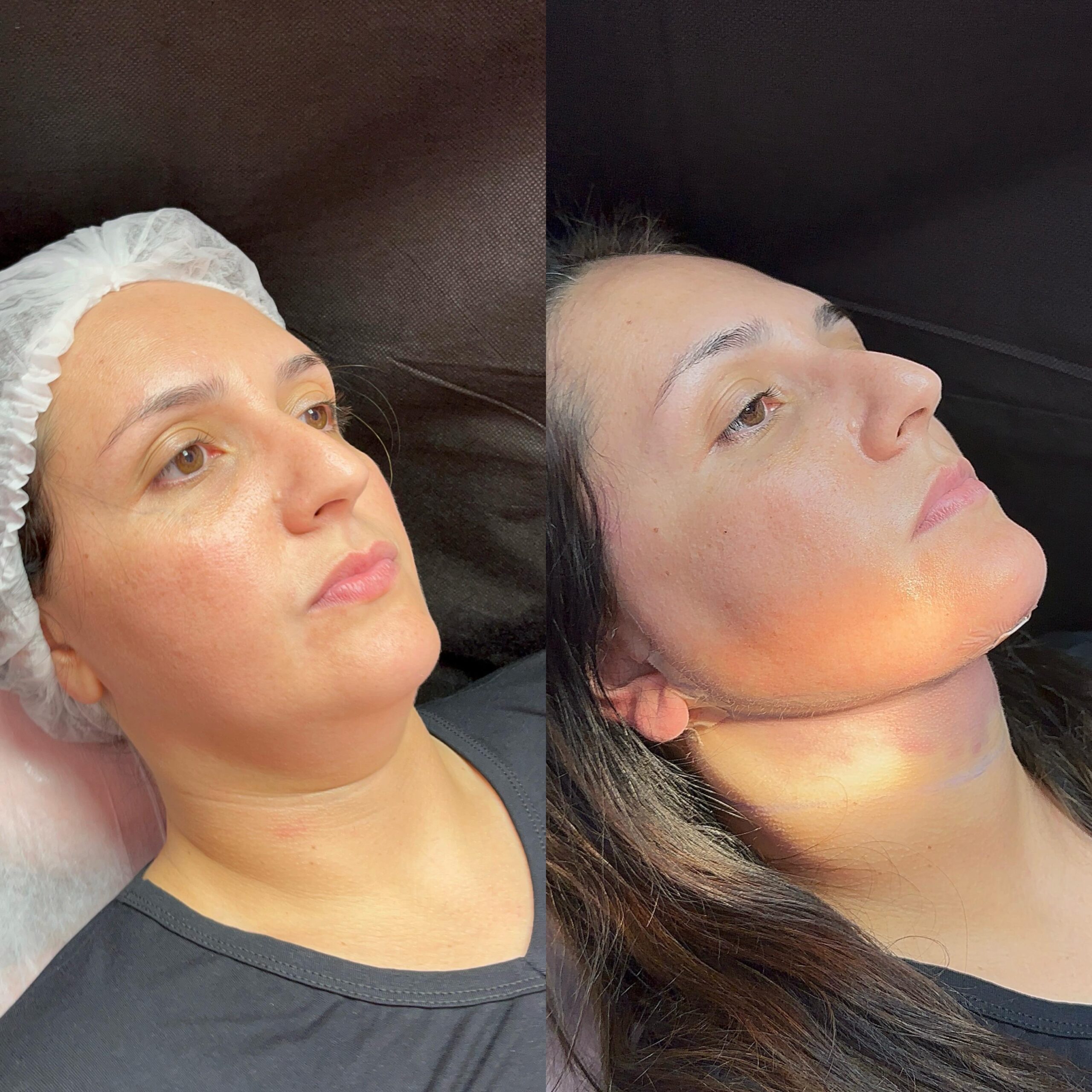 harmonizaçãp-facial
