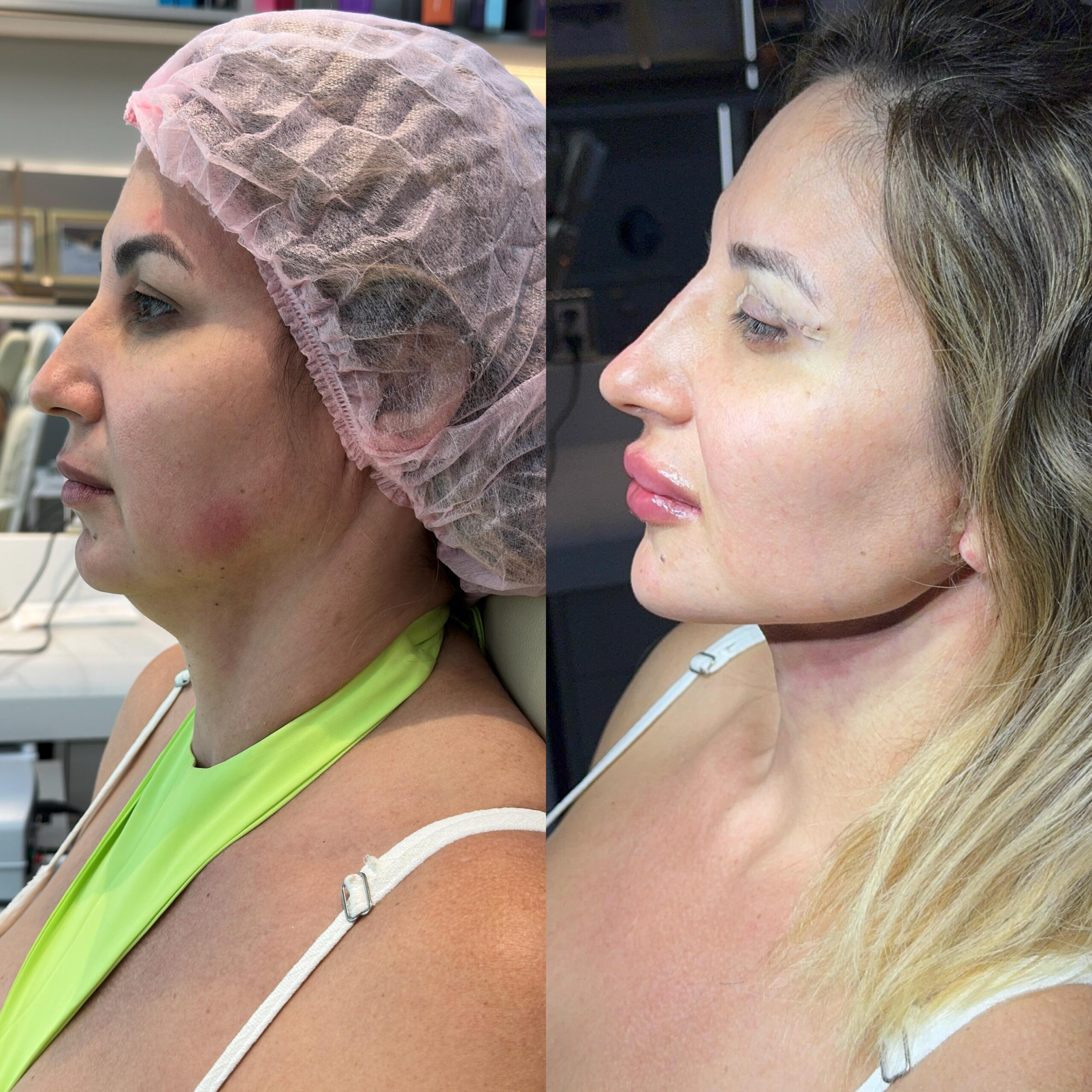 rejuvenescimento-cervical-são-paulo